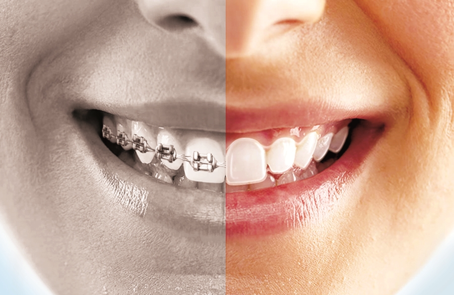 bracess braces