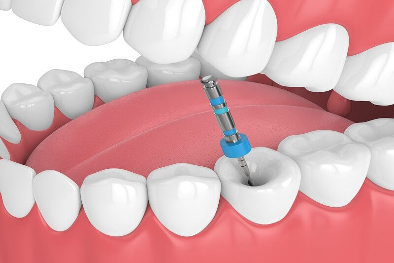 root canal root canal